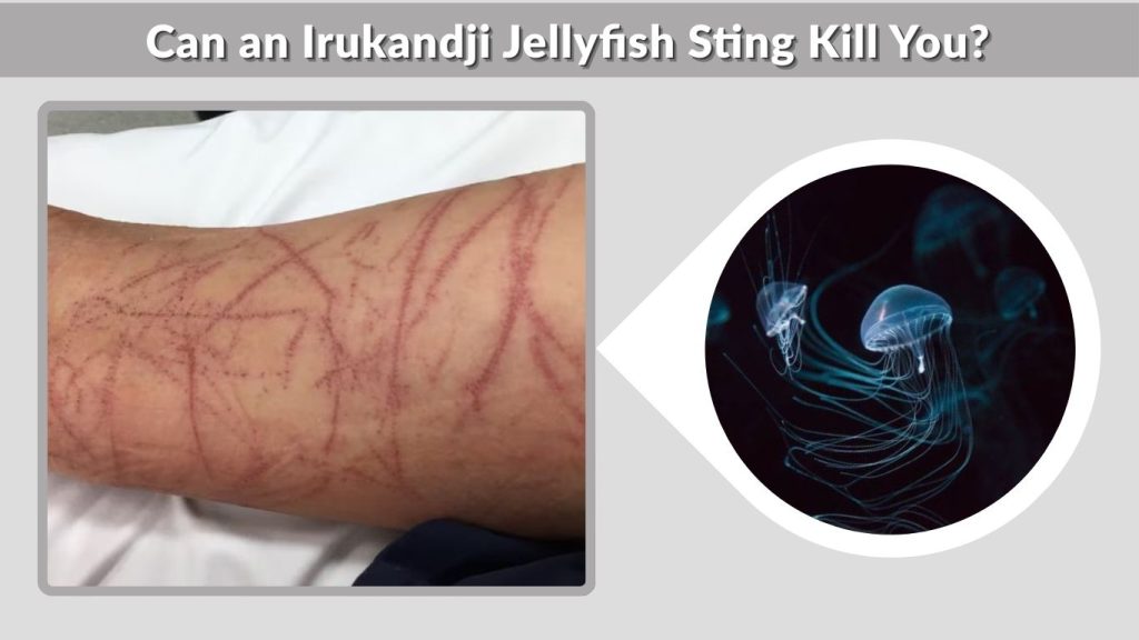 Can an Irukandji Jellyfish Sting Kill You?