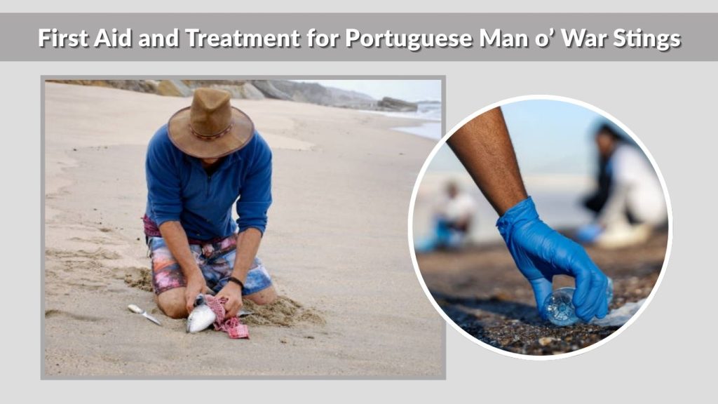 First Aid and Treatment for Portuguese Man o’ War Stings