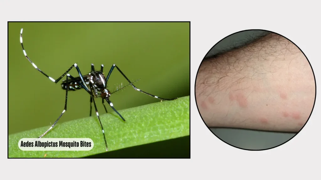 Aedes Albopictus Mosquito Bites