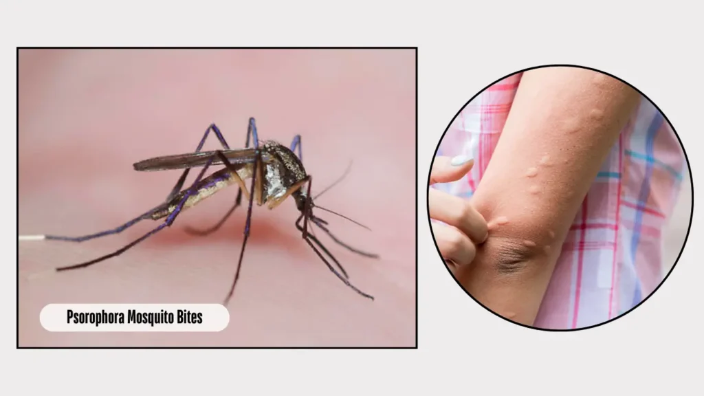 Psorophora Mosquito Bites