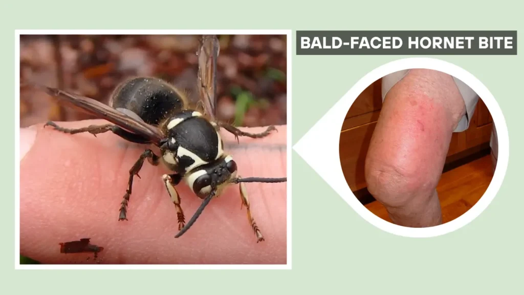 Bald-Faced Hornet Bite