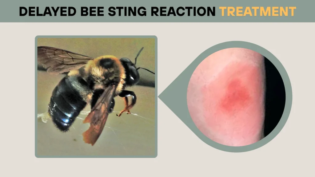 Delayed Bee Sting Reaction Treatment