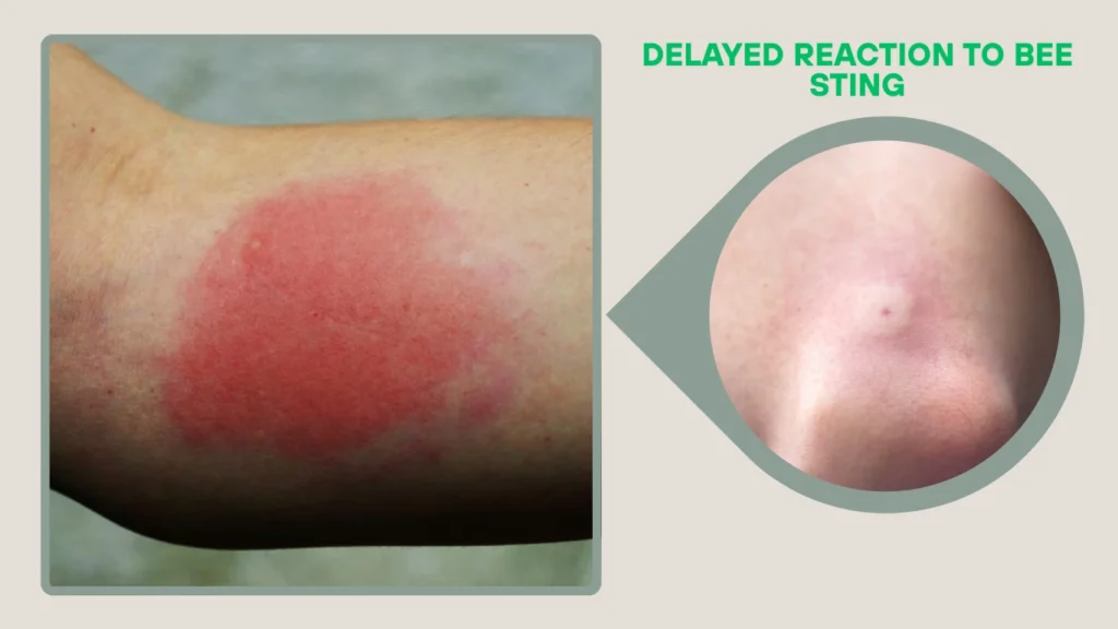 Delayed Reaction to Bee Sting