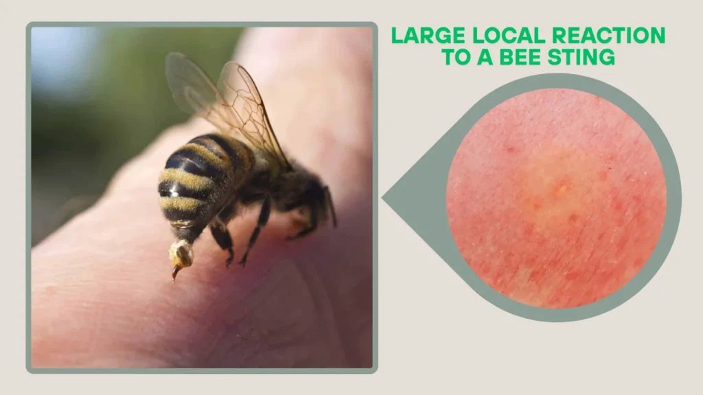 12. Large Local Reaction to a Bee Sting
