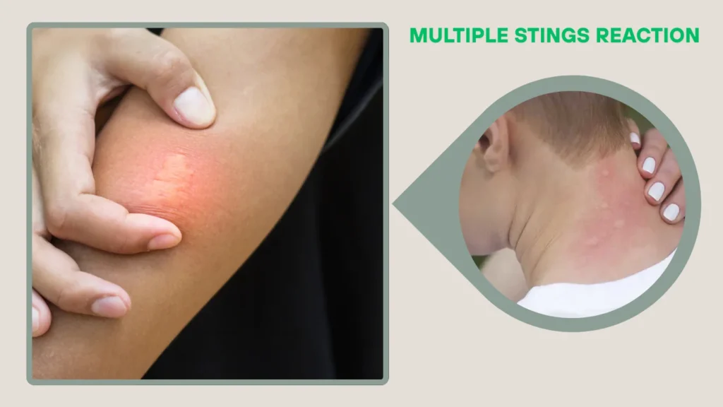 Multiple Stings Reaction