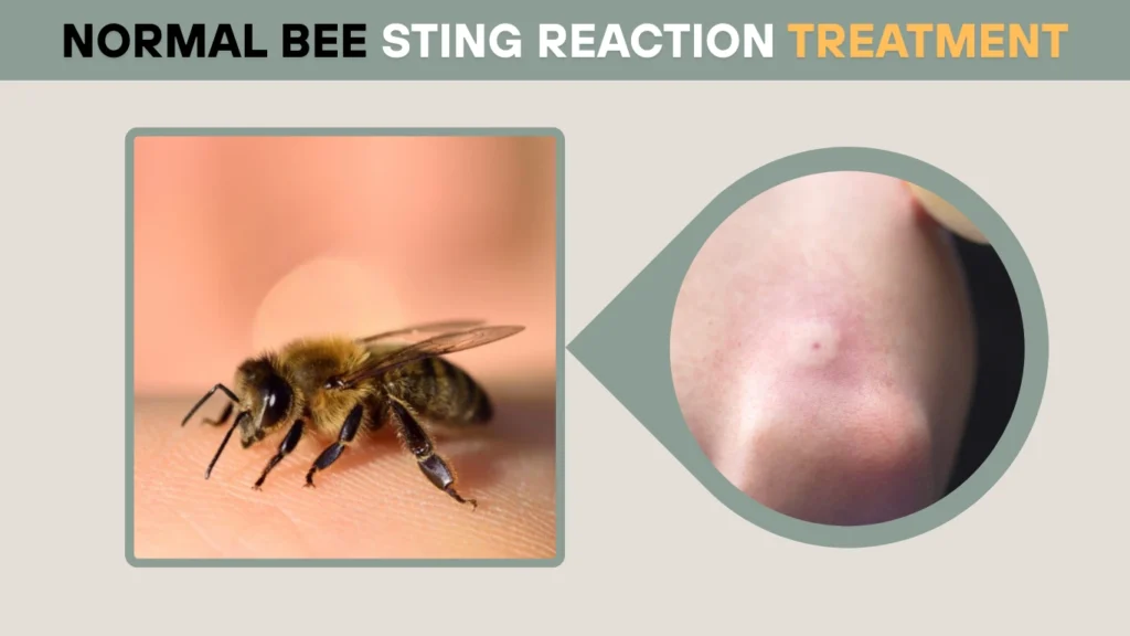 Normal Bee Sting Reaction Treatment