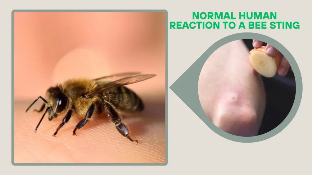 Normal Human Reaction to a Bee Sting