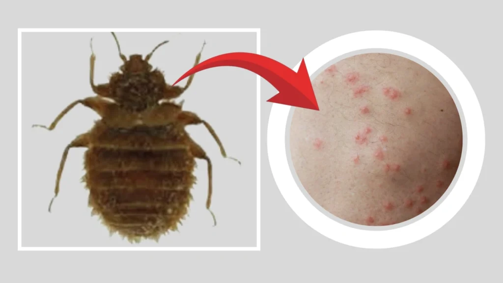 What Do Paracimex setosus Bites Look Like