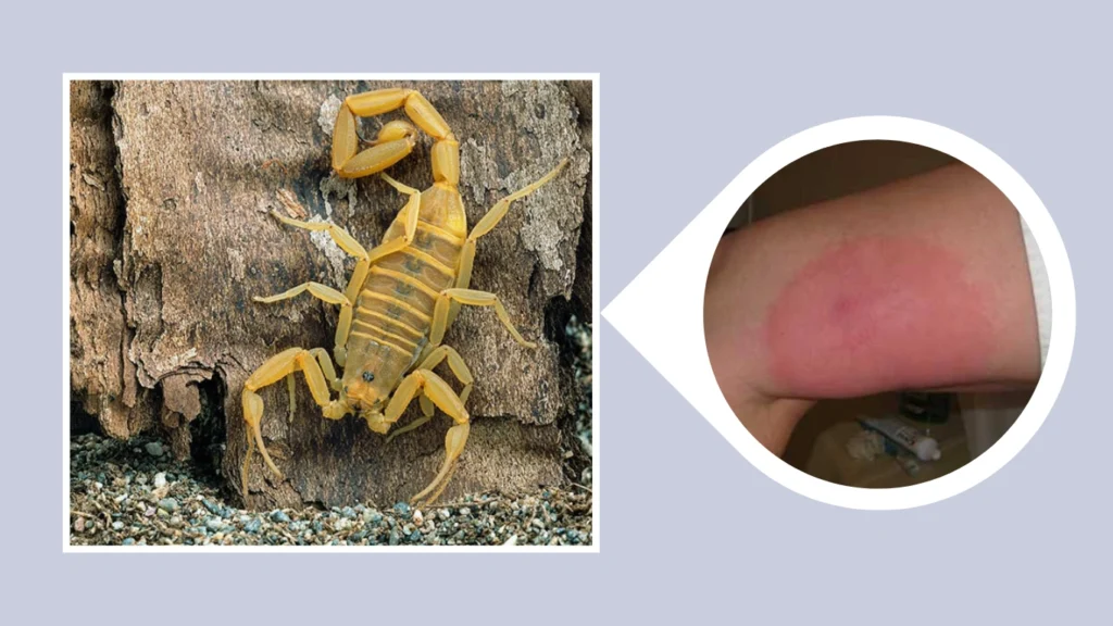 arizona bark scorpion sting