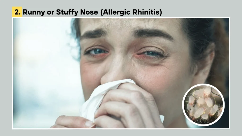 2. Runny or Stuffy Nose (Allergic Rhinitis)
