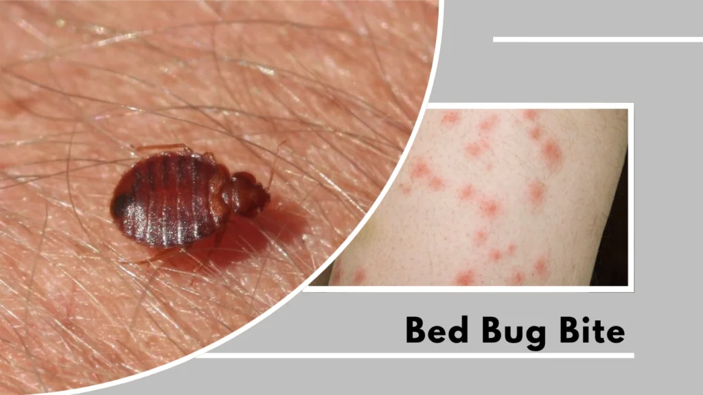 Bed Bug Bite