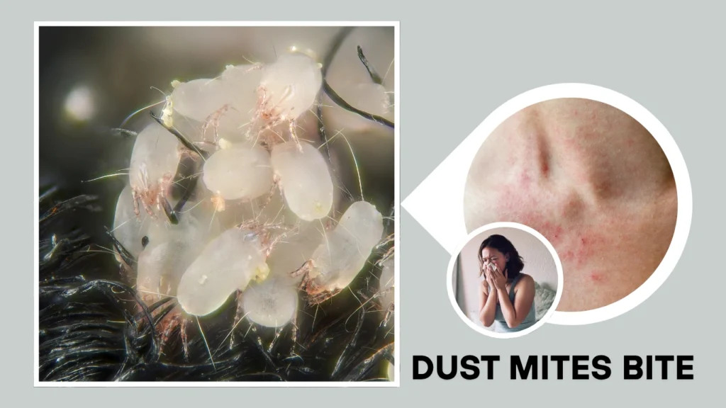 Dust Mite Bites Symptoms Identification With Pictures Dust Mite Bites Symptoms Identification With Pictures