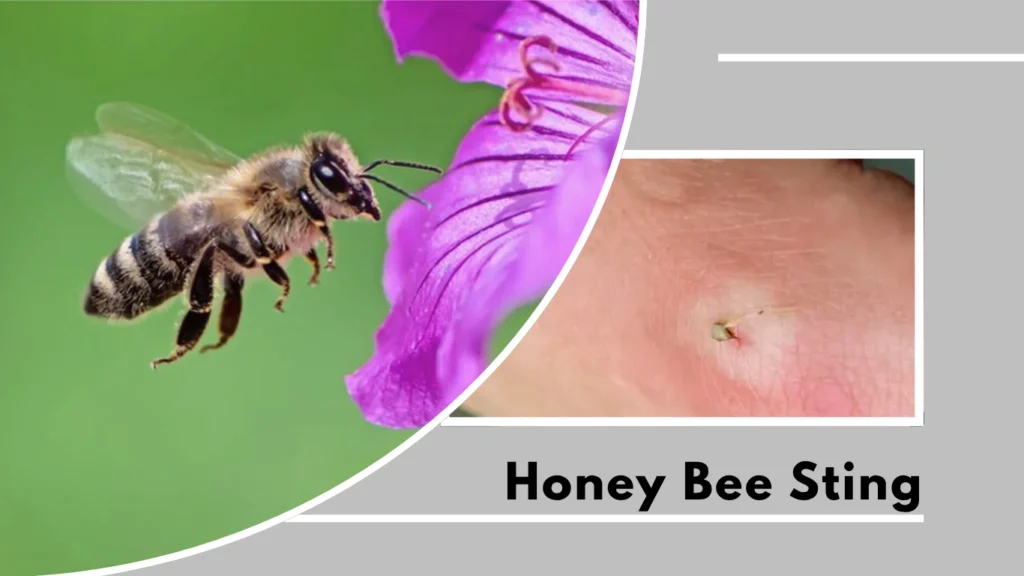 Honey Bee Sting