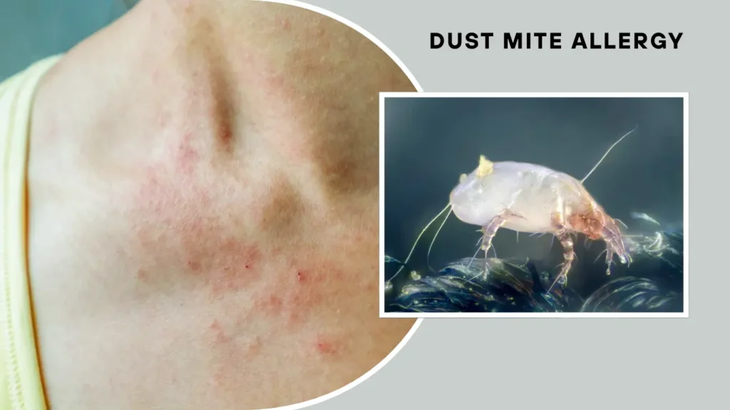 What Is a Dust Mite Allergy