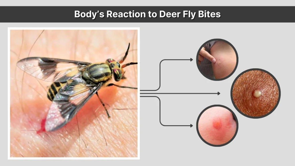 Body’s Reaction to Deer Fly Bites