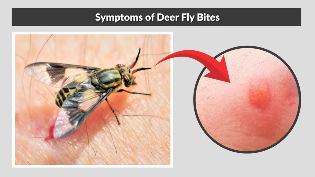 Symptoms of Deer Fly Bites