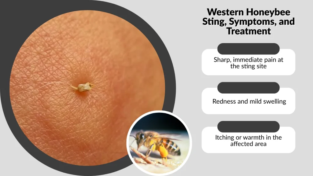 Western Honeybee Sting, Symptoms, and Treatment
