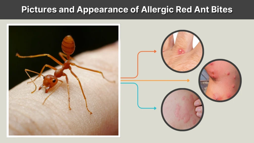 Pictures and Appearance of Allergic Red Ant Bites