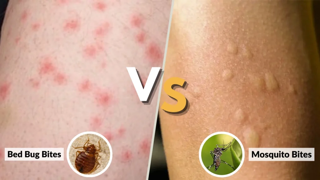Symptoms of Bed Bug Bites vs Mosquito Bites