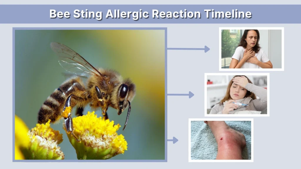 Bee Sting Allergic Reaction Timeline