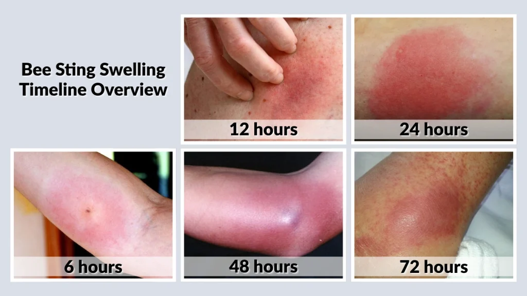 Bee Sting Swelling After 6 12 24 48 And 72 Hours