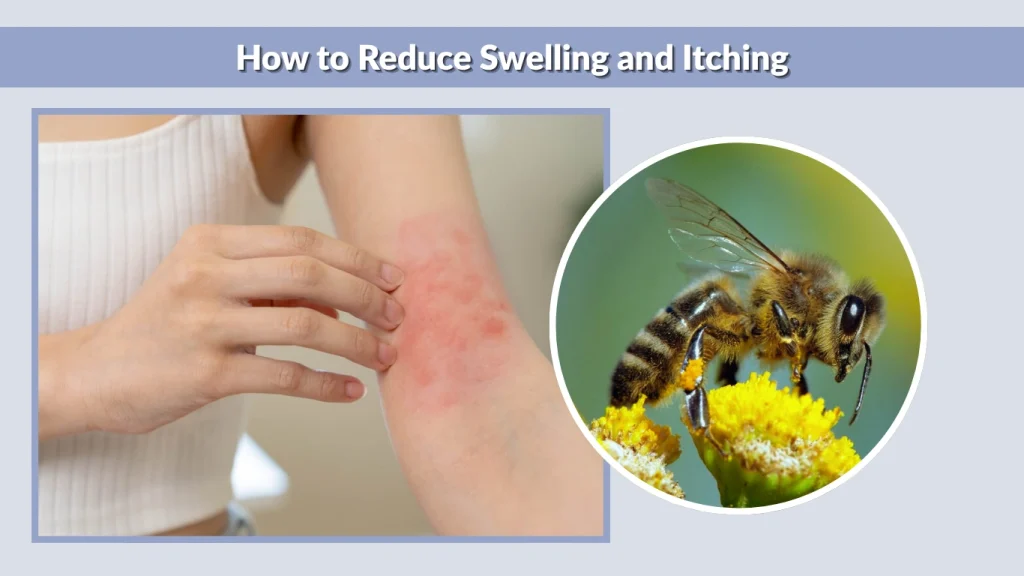 How to Reduce Swelling and Itching