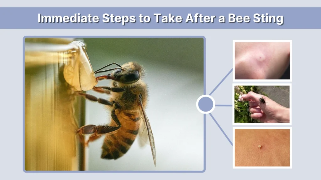 Immediate Steps to Take After a Bee Sting