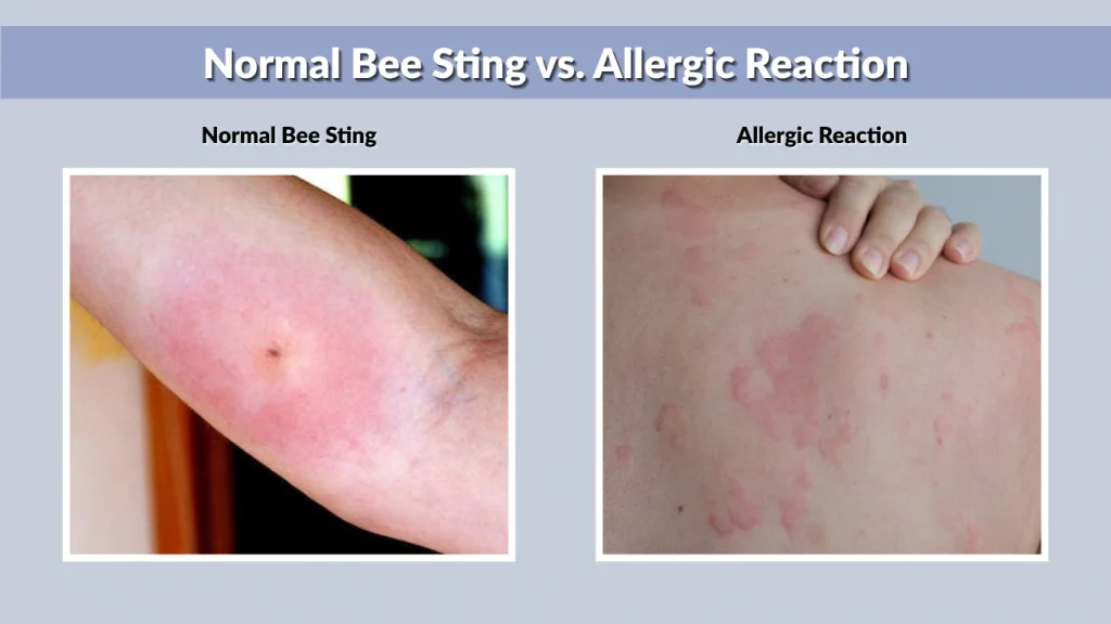 Bee Sting Allergic Reaction Symptoms Causes Treatment Guide