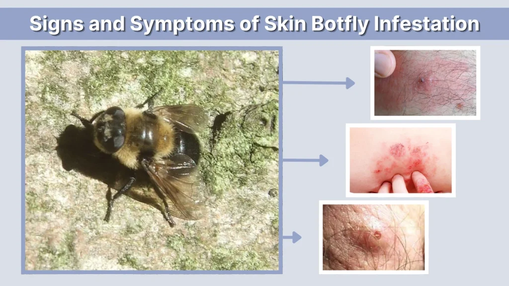Signs and Symptoms of Skin Botfly Infestation