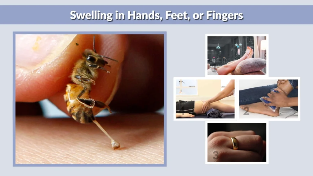 Swelling in Hands, Feet, or Fingers