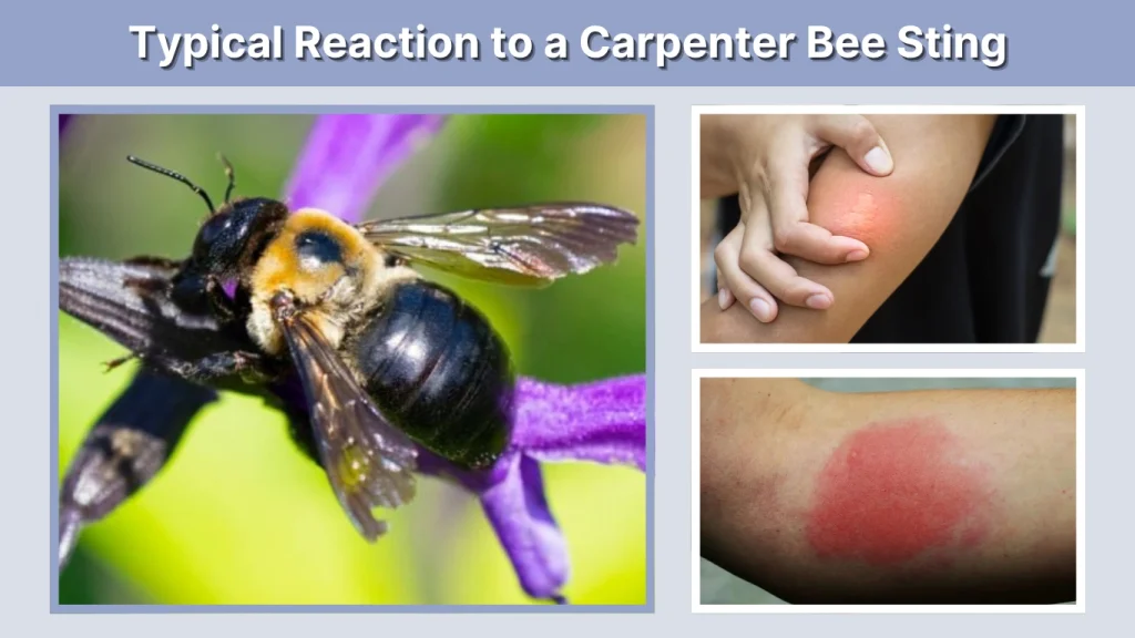 Typical Reaction to a Carpenter Bee Sting