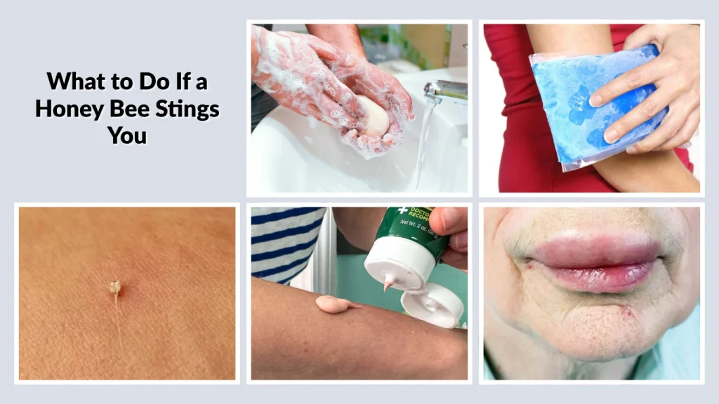 What to Do If a Honey Bee Stings You