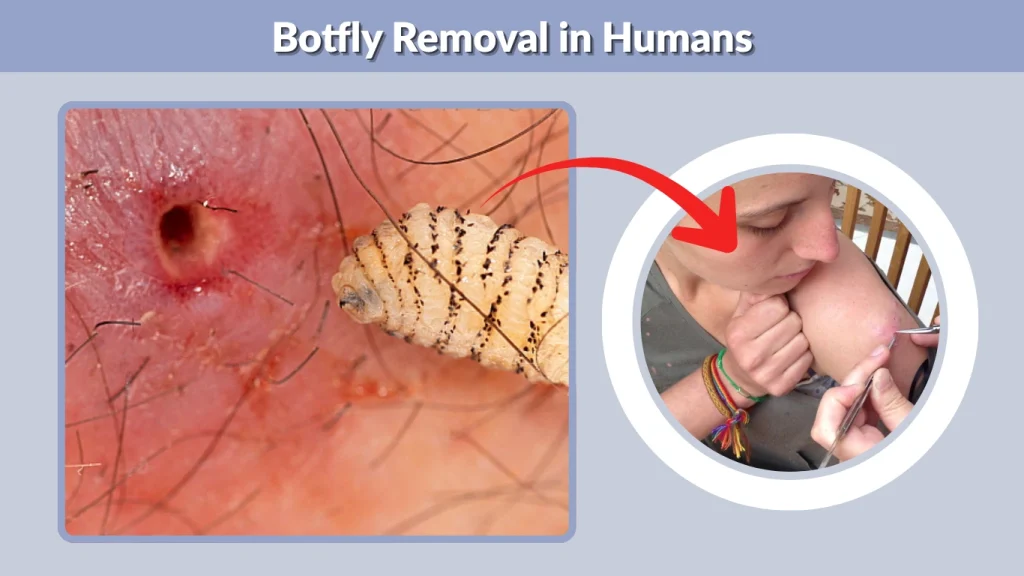 Botfly Removal in Humans