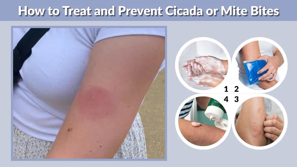 How to Treat and Prevent Cicada or Mite Bites