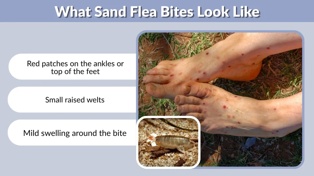 Sand Fleas: Identification, Bites, Treatment & Removal