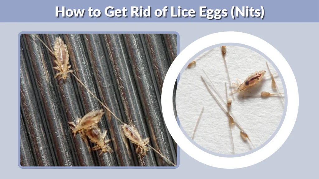 How to Get Rid of Lice Eggs (Nits)