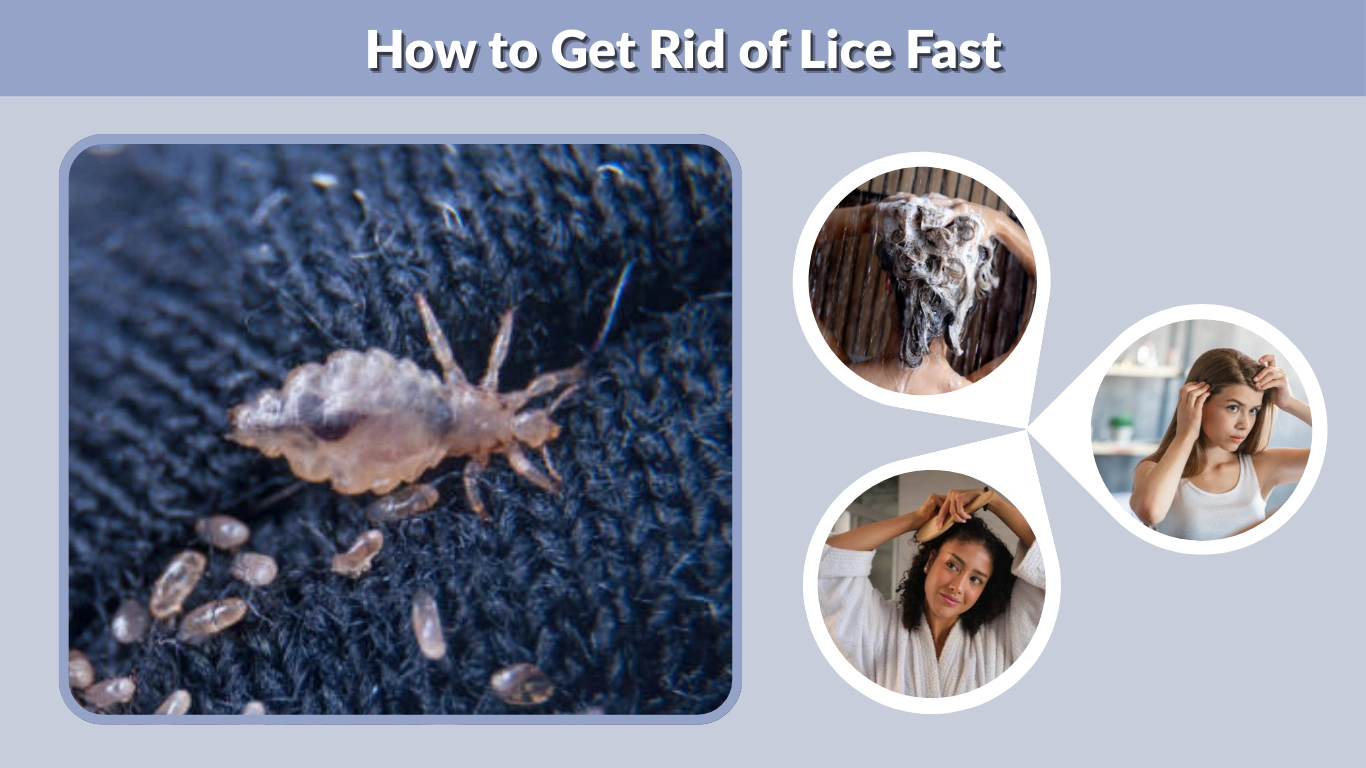How to Get Rid of Lice Fast Head Lice & Home Remedies