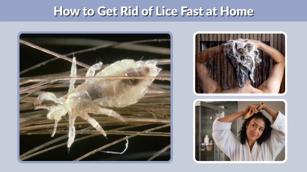 How to Get Rid of Lice Fast at Home