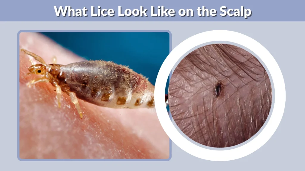 What Lice Look Like on the Scalp