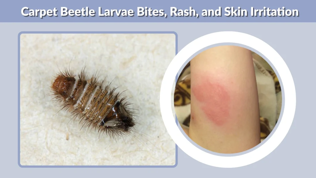 Carpet Beetle Larvae Bites, Rash, and Skin Irritation
