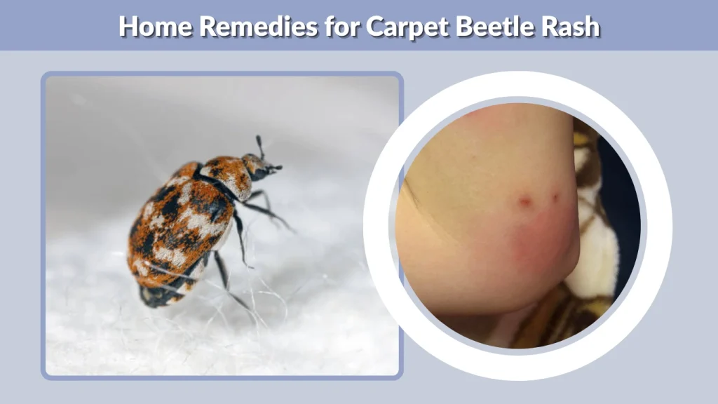 Home Remedies for Carpet Beetle Rash