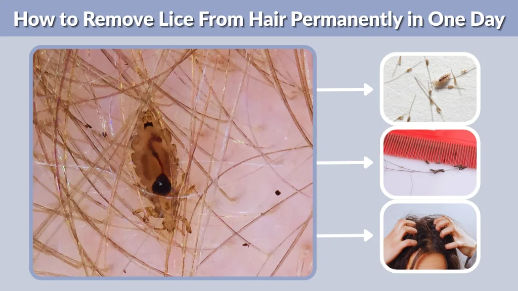 How to Remove Lice From Hair Permanently in One Day