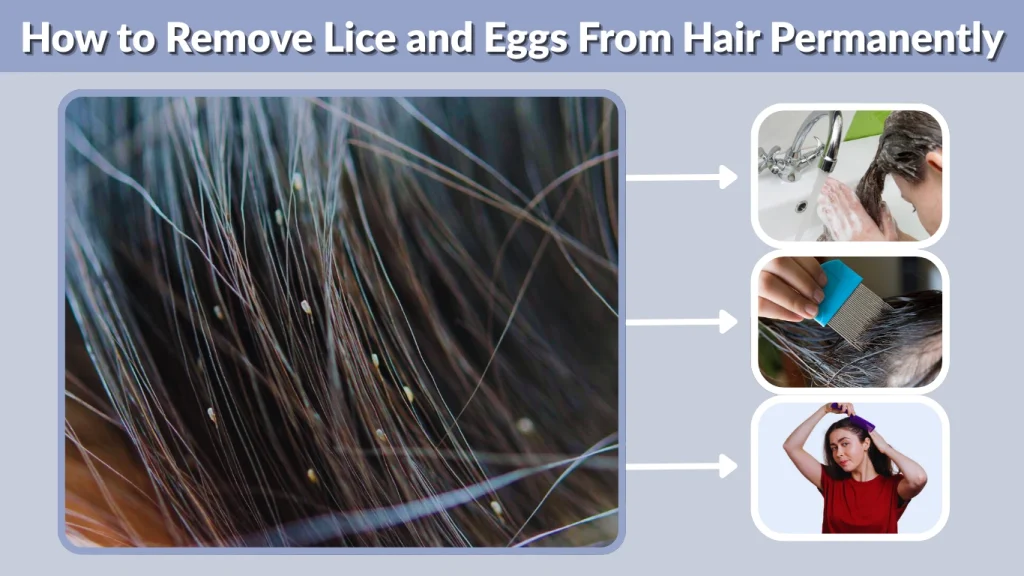 How to Remove Lice and Eggs From Hair Permanently
