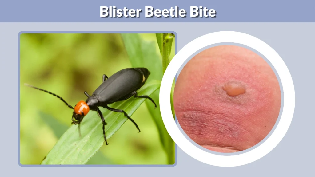 Blister Beetle Bite