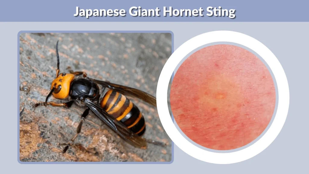 Japanese Giant Hornet Sting