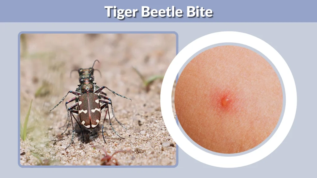 Tiger Beetle Bite