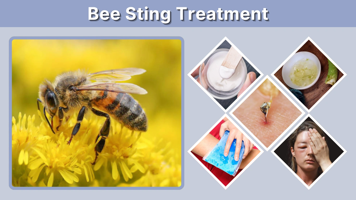 Bee Sting Treatment Home Remedies, Relief & Care Guide