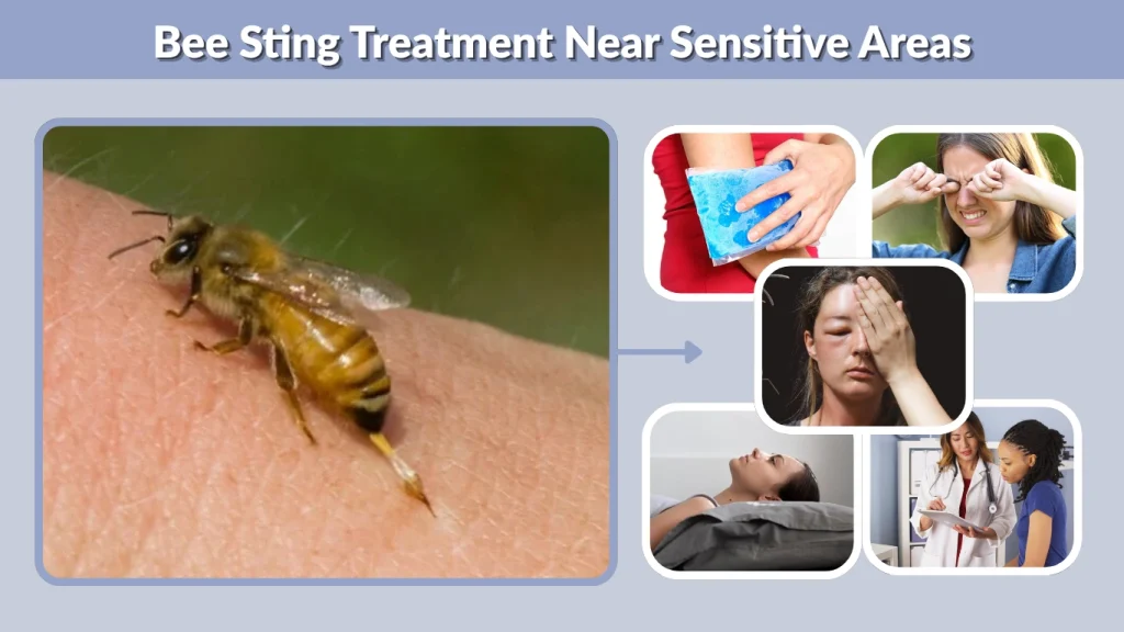 Bee Sting Treatment Near Sensitive Areas