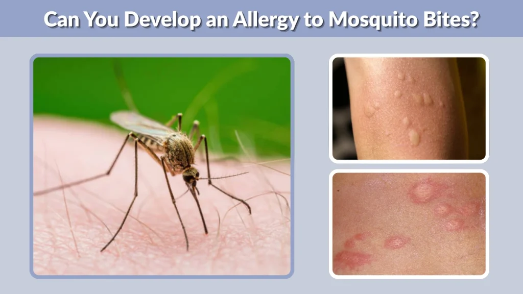Can You Develop an Allergy to Mosquito Bites