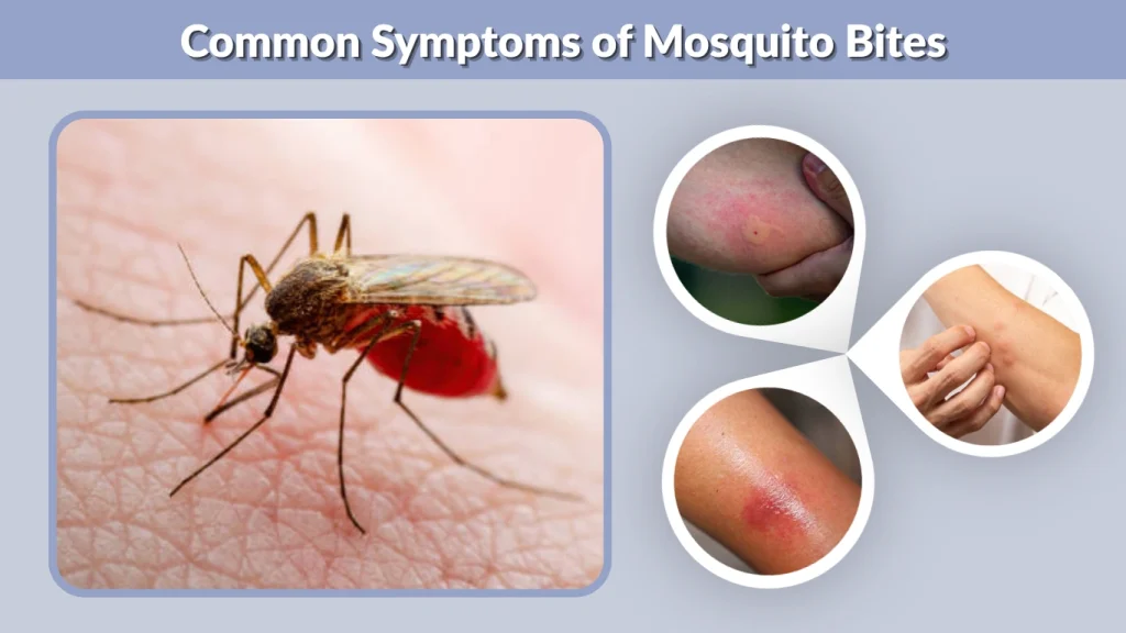 Common Symptoms of Mosquito Bites